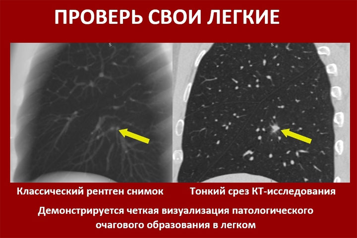 ДЦ «Абакан» пригласил жителей Хакасии пройти компьютерную томографию легких